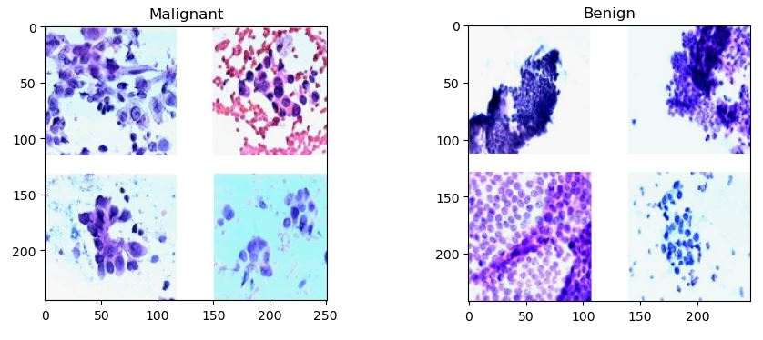 Example breast cancer images - benign vs malignant.