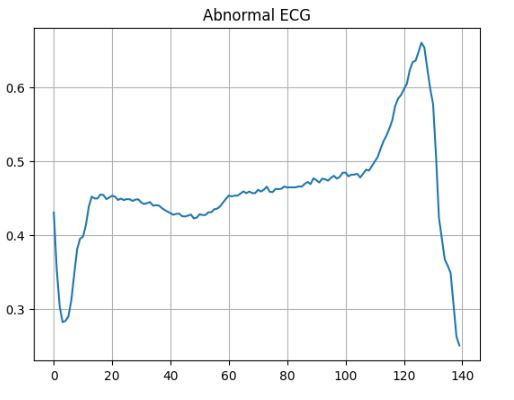 Abnormal ECG